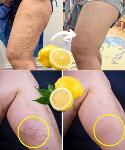 Lemon Removes Varicose Veins! This Is What You Need To Do...