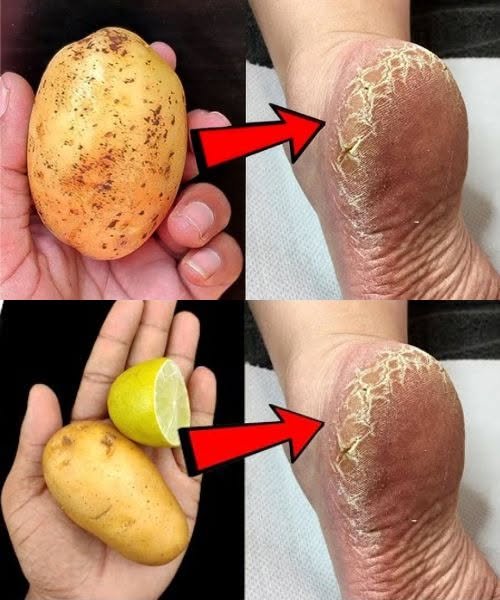 Eliminate Cracked Heels and Get Smooth, White Feet: Magic Potato Home Remedy