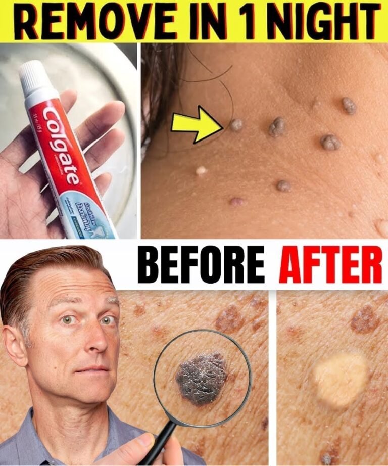 🌿 Say Goodbye to Warts & Skin Tags—The Natural Way That Works