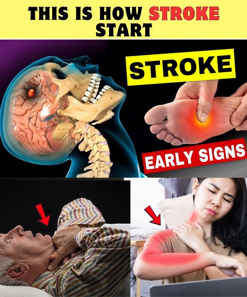 8 Warning Signs of Stroke One Month Before (And 9 Powerful Tips to Prevent It)