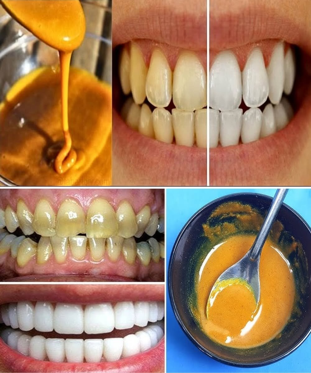 Homemade Toothpaste to Whiten Teeth & Reverse Gum Disease Using Turmeric, Coconut Oil & Peppermint