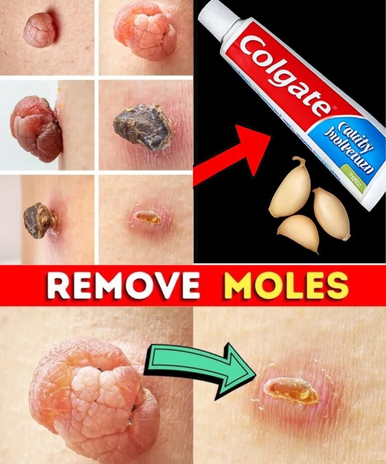 🌿 3-Ingredient Natural Remedy for Skin Tags & Warts