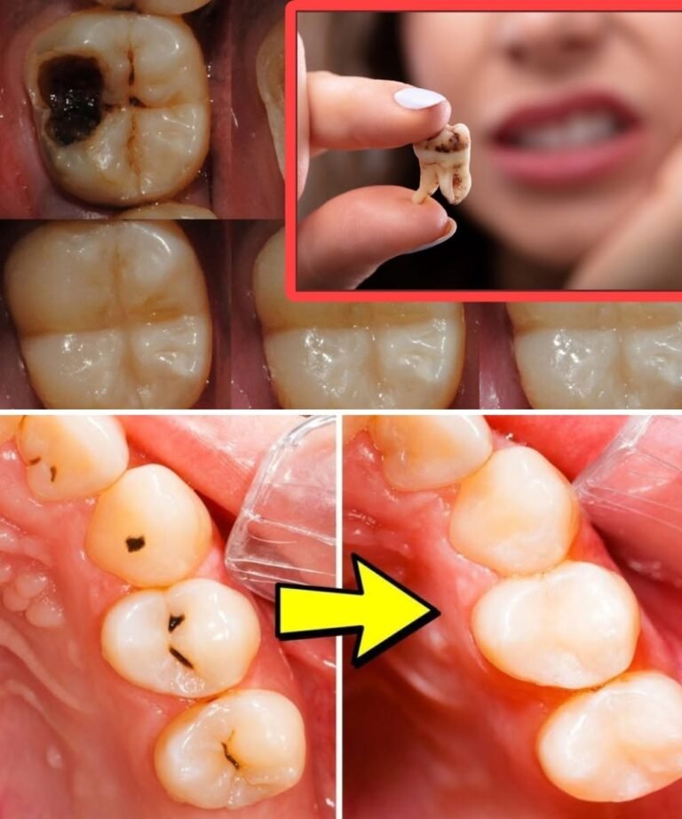 How to Naturally Repair a Cavity: Tips to Keep Your Teeth Strong & Avoid the Dentist