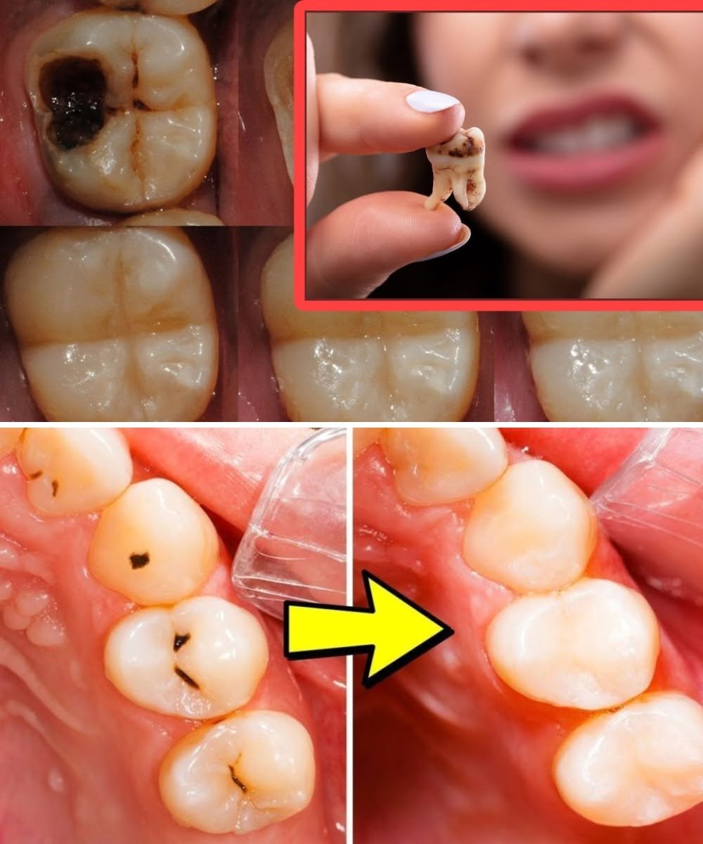 How to Naturally Repair a Cavity: Tips to Keep Your Teeth Strong & Avoid the Dentist