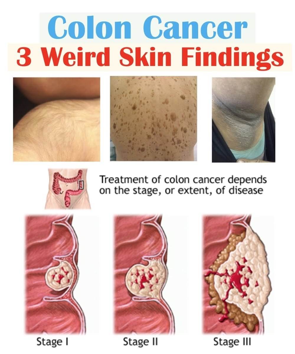 3 Weird Skin Signs That May Point to Colon Cancer (Yes, Really!)