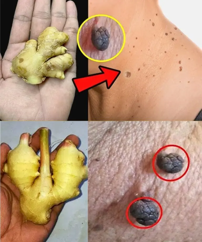 🍋 How I Naturally Removed Skin Tags at Home with Lemon & Ginger