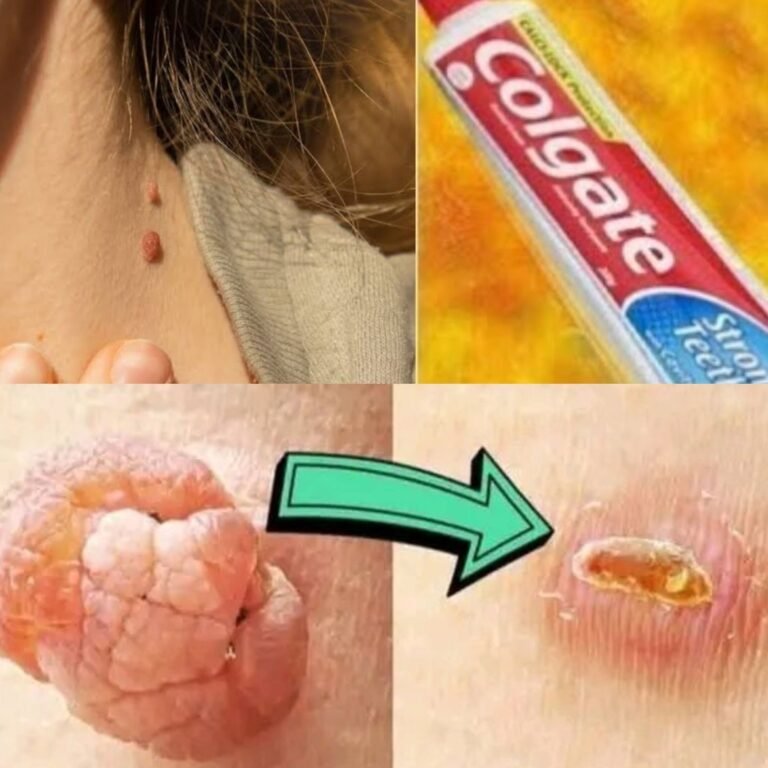 Remove Skin Tag Overnight With Toothpaste Remedy (100% Working)