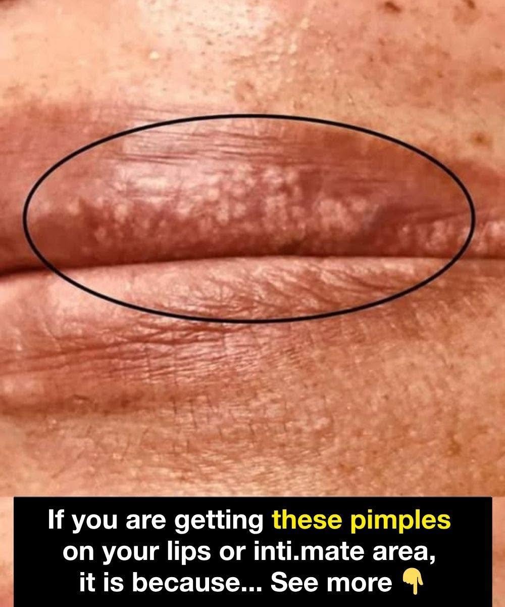 Pimples on Your Lips: Why They Happen and What You Should Do About Them