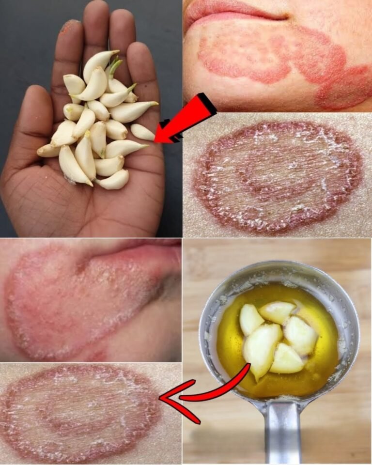Garlic and Olive Oil: A Powerful Home Remedy to Soothe Fungal Skin Infections Naturally