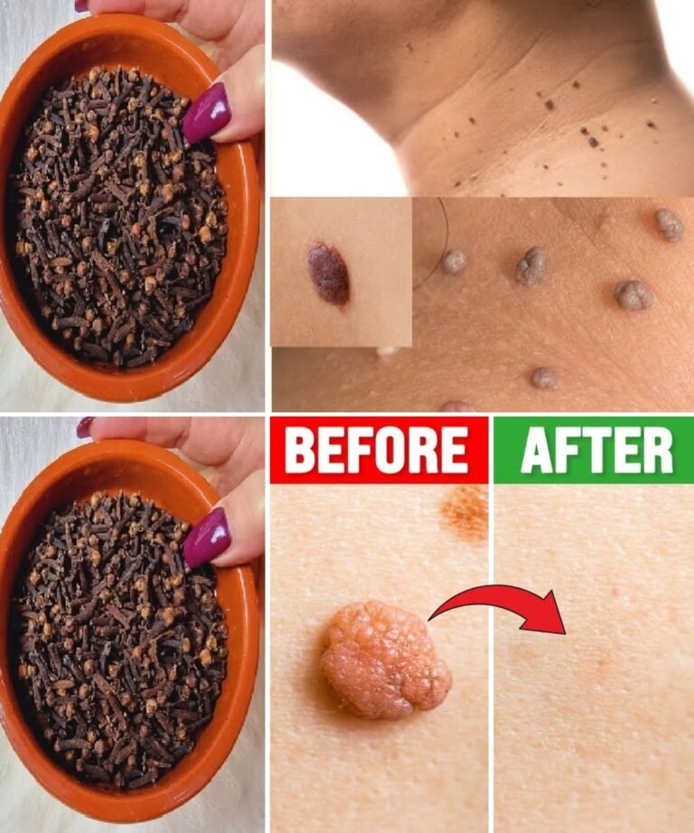 The Natural Clove Remedy for Skin Tags & Warts: Gentle, Effective, and Time-Tested