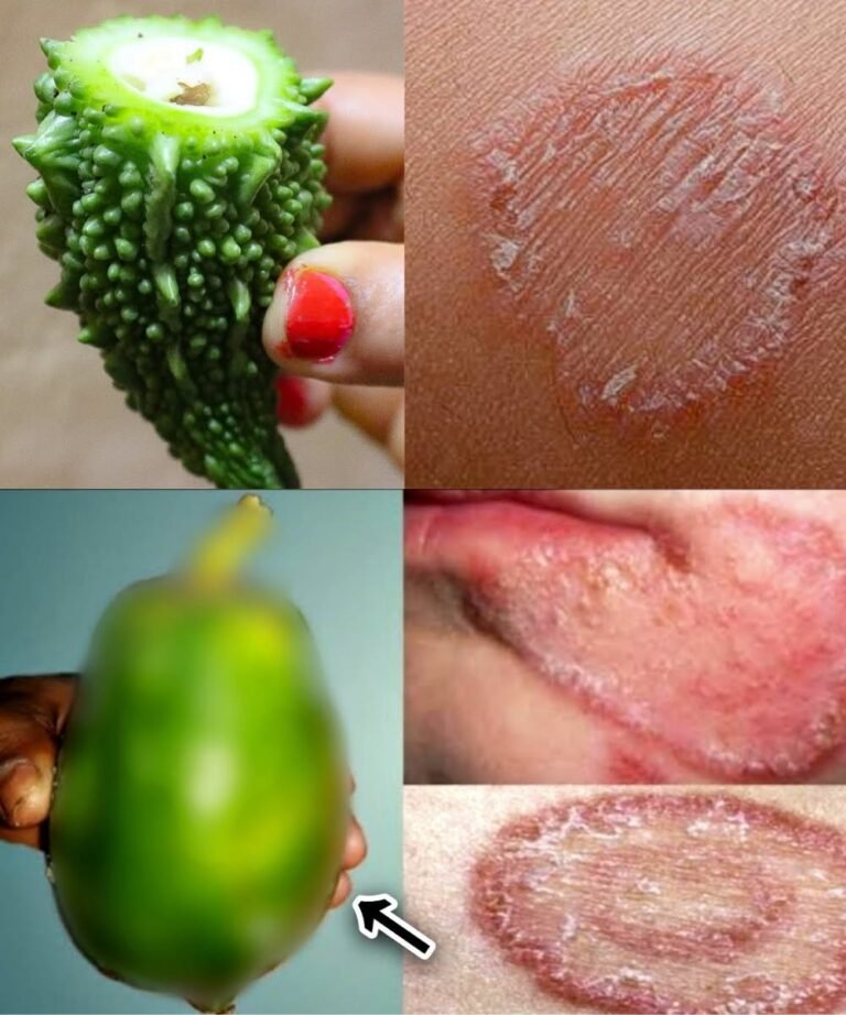 9 Powerful Home Remedies to Get Rid of Fungal Infection
