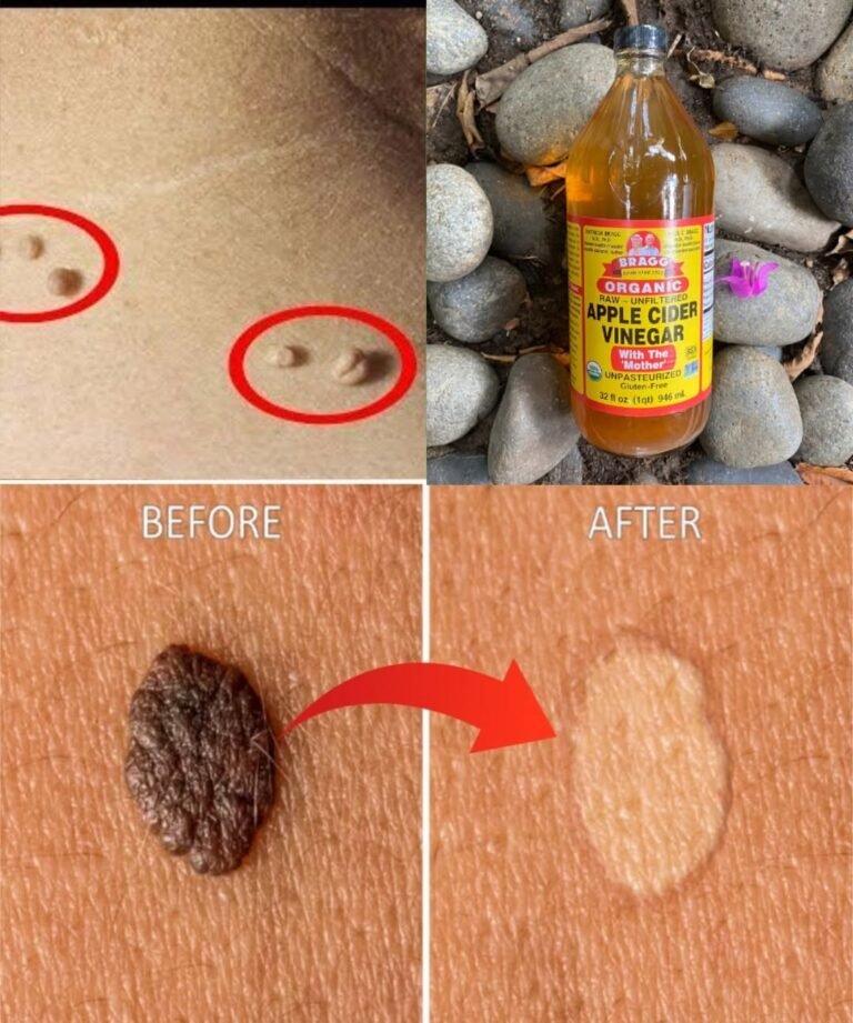 How to Fade a Skin Mole Naturally (Safely and Gently)