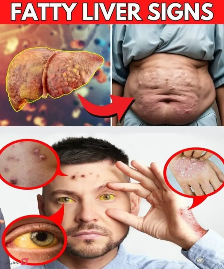 WARNING! 8 Mysterious Symptoms That Are Damaging Your Liver | Fatty Liver