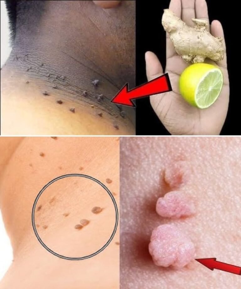 How I Gently Removed Skin Tags at Home Using Lemon & Ginger