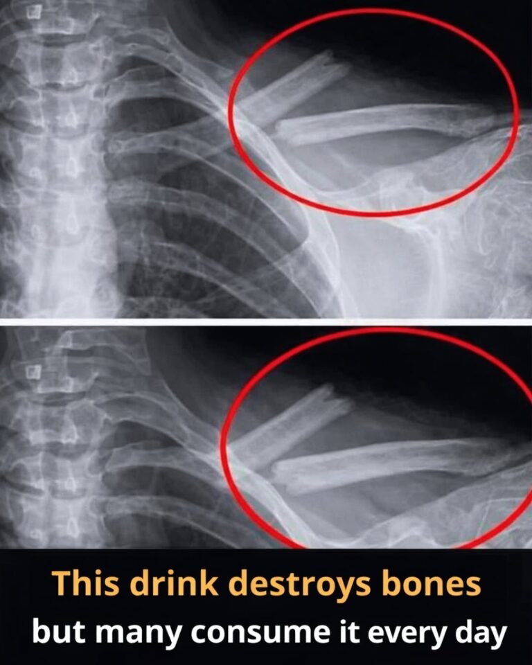 Does This Drink Harm Your Bones? The Hidden Effects of Soda on Your Health