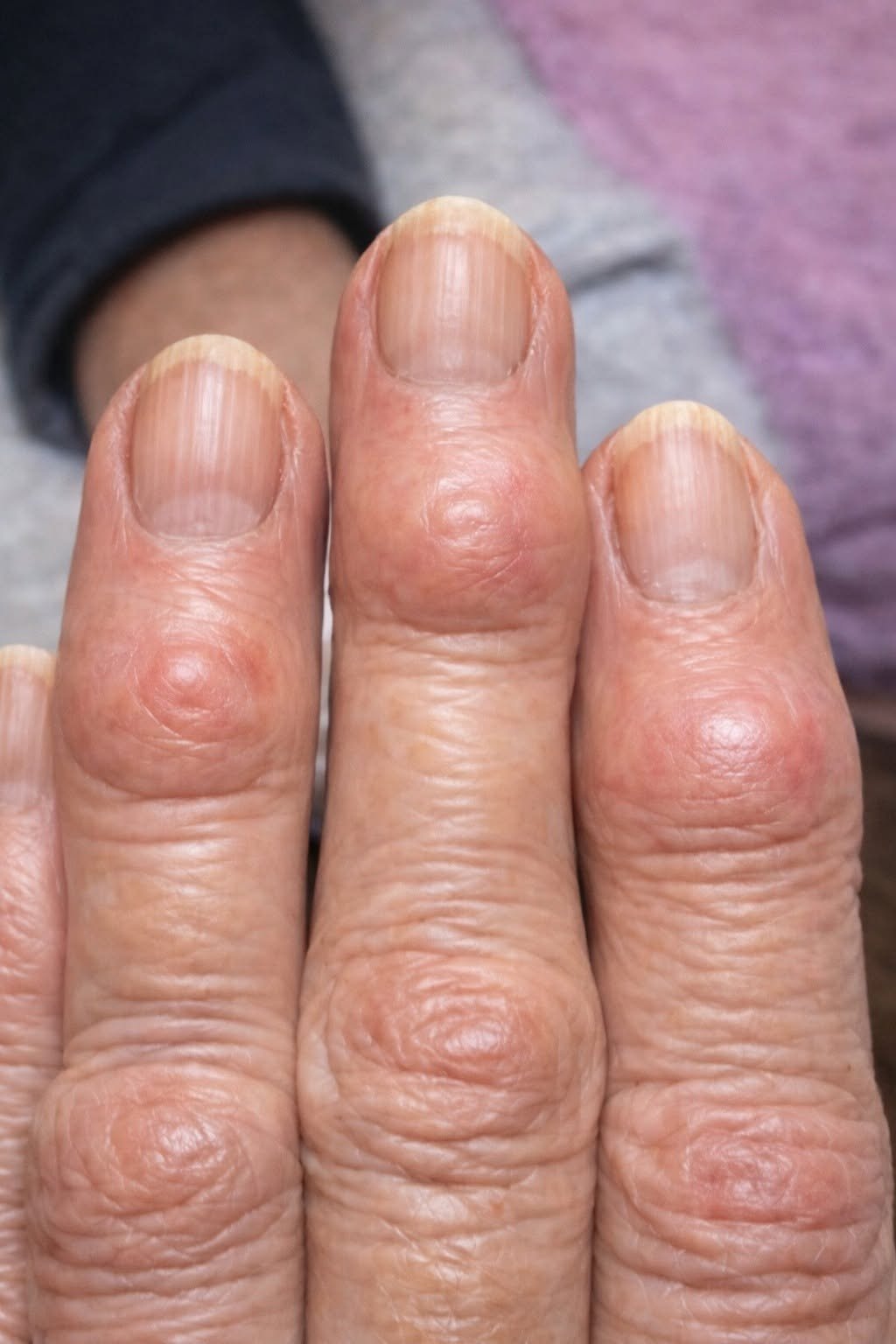 Hard Bumps on Finger Joints Near the Nails: What They Could Mean