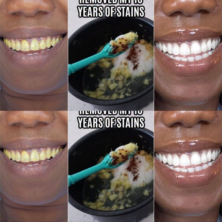 In Two Minutes Remove 10 Years of Stains from Teeth!! Results Will Shock You