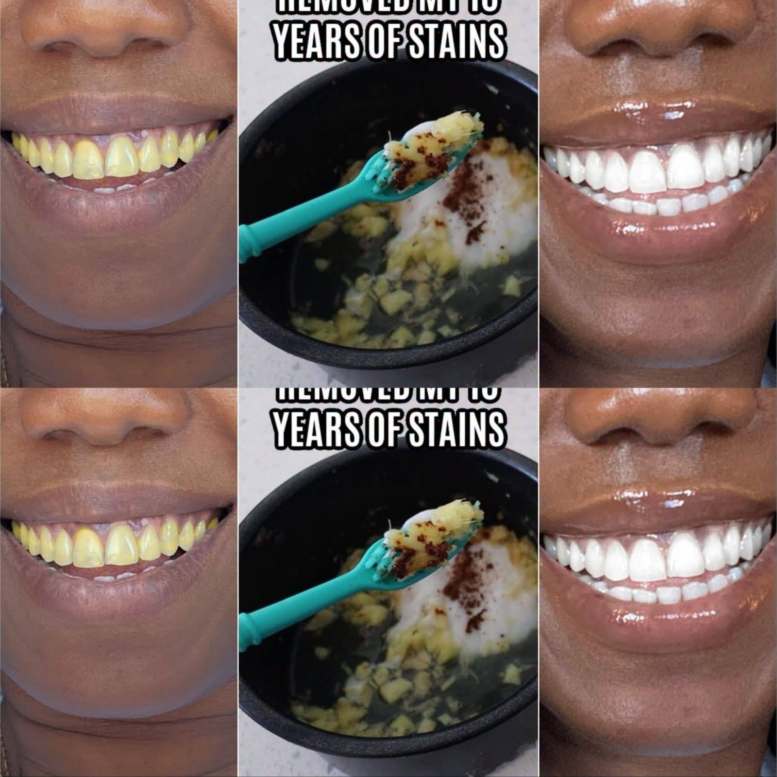 In Two Minutes Remove 10 Years of Stains from Teeth!! Results Will Shock You