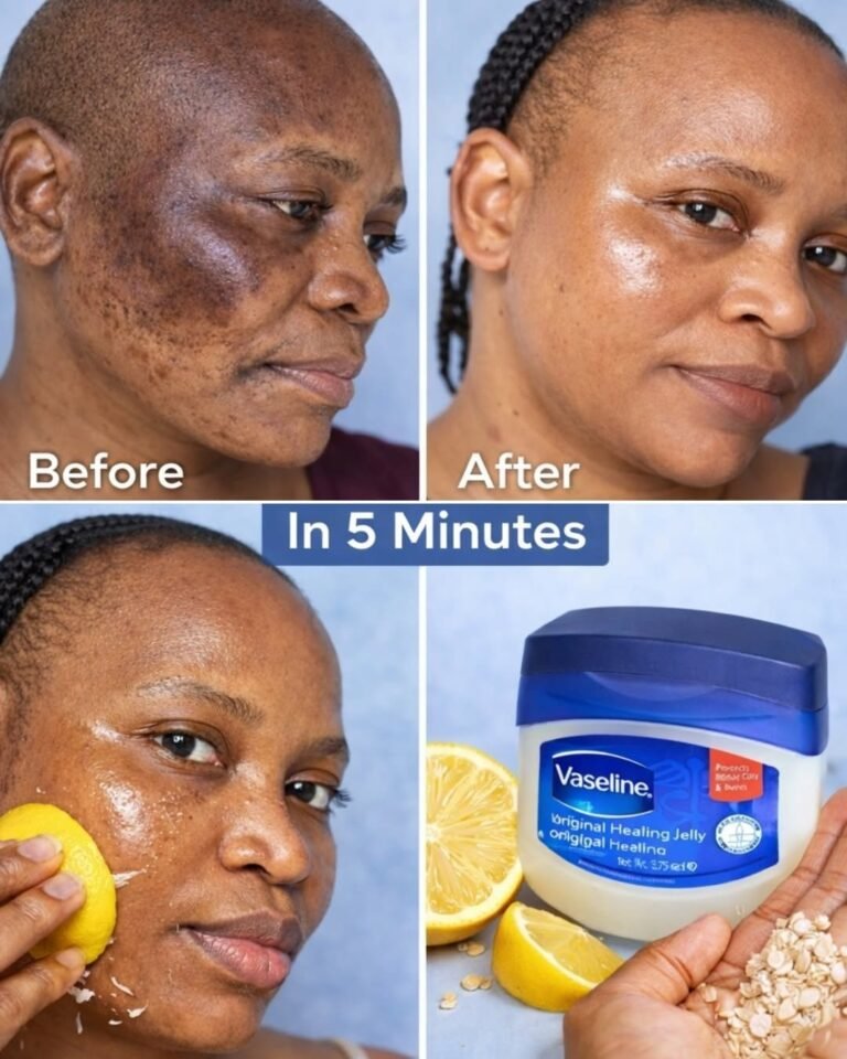 Can Lemon Juice Fade Acne Marks? Try This Natural Remedy