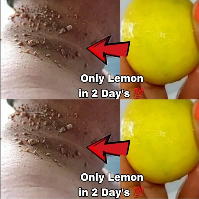 DIY Skin Tag Removal in 3 Days? The Lemon & Toothpaste Remedy Everyone Is Talking About 💞