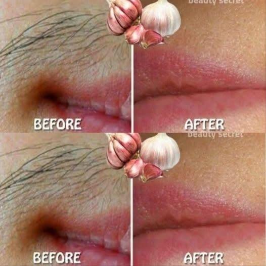 Stop Shaving! The Garlic Hair-Removal Trick Everyone Is Talking About