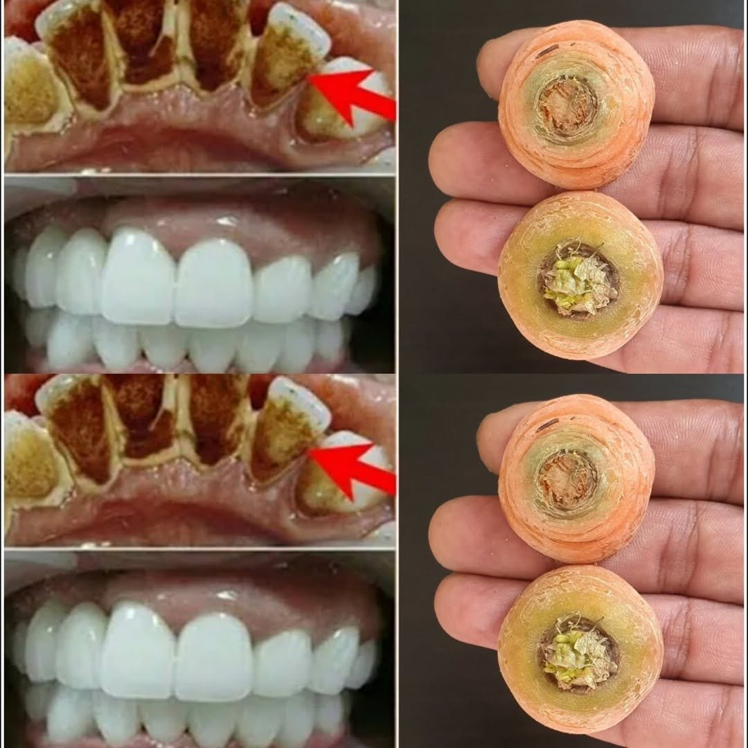 Whiten Your Teeth Naturally in 2 Minutes!Carrot Tops: A Surprising Home Remedy for a Bright Smile