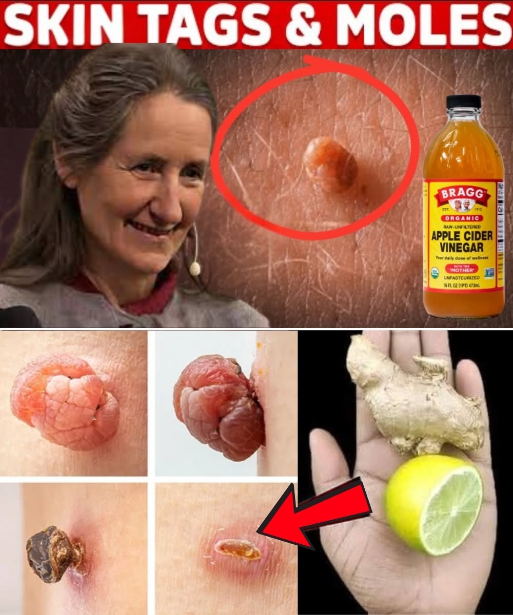 Plantar Warts and Skin Tags Disappear Naturally—Try This Overnight Remedy