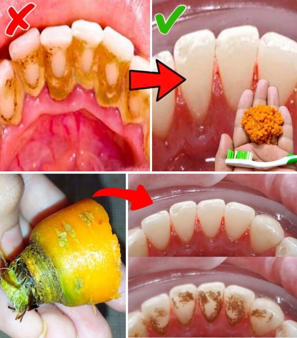 Home Teeth Whitening: Get Whiter Teeth in Just 2 Minutes!