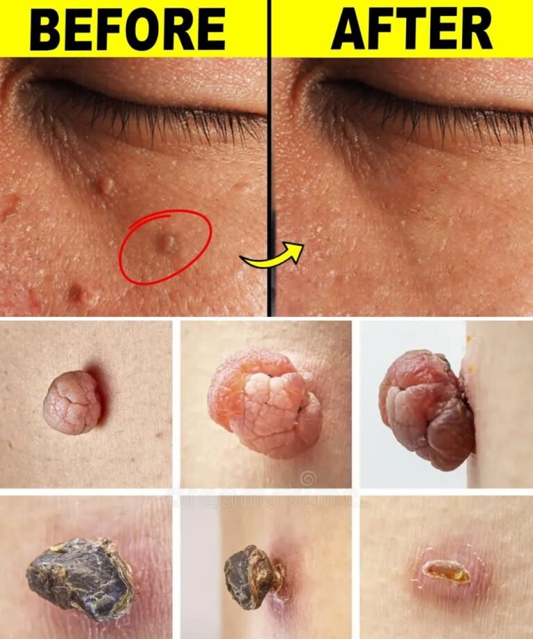 8 Natural Ways to Get Rid of Milia (White Bumps) Using Simple Home Ingredients