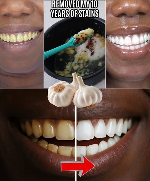 In Two Minutes, Remove 10 Years of Stains from Your Teeth! The Results Will Shock You