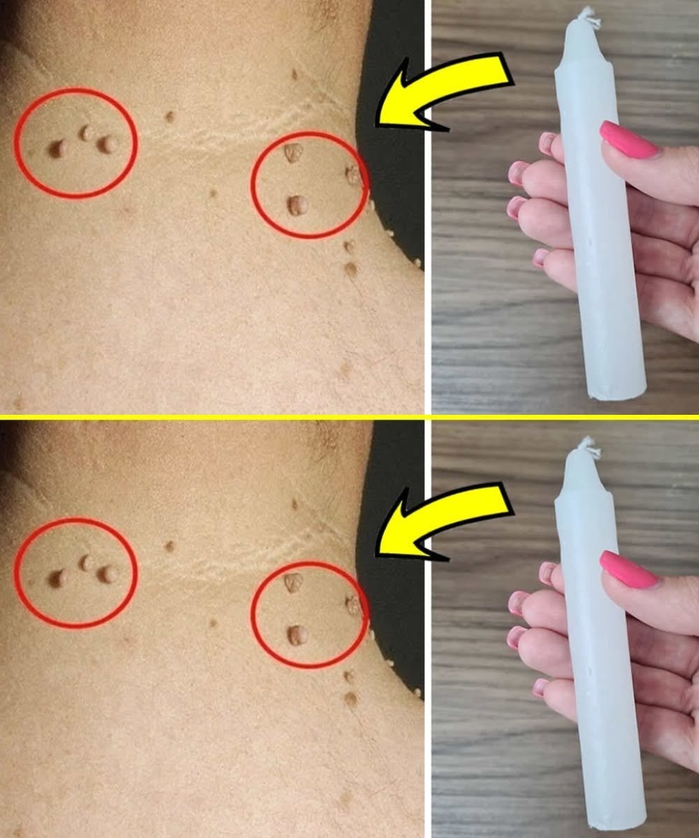 How to Permanently Remove Warts Using Candle Wax: A Natural Remedy That Works