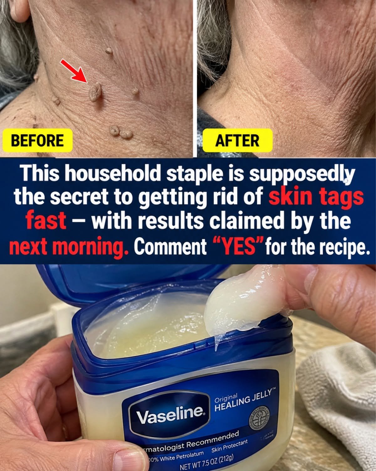Vaseline + Skin Tags: The Friction Shield Nobody Talks About
