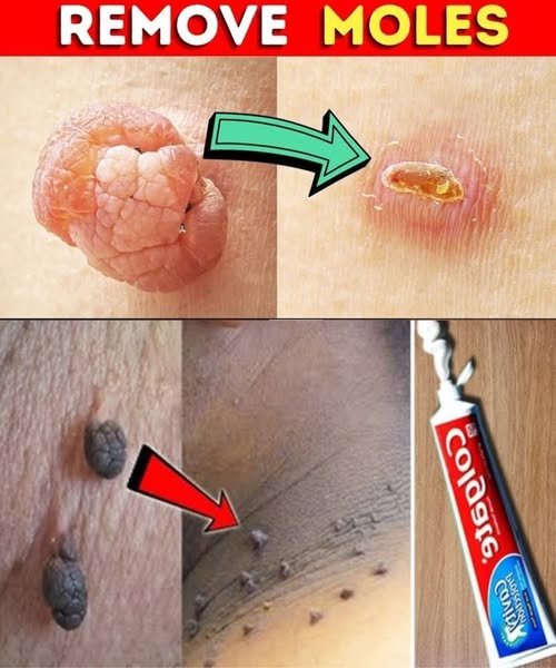 Say Goodbye to Warts and Skin Tags Naturally: A Simple Remedy That Really Works