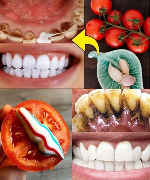 The Strongest Teeth Whitening Recipe at Home in Just 2 Minutes