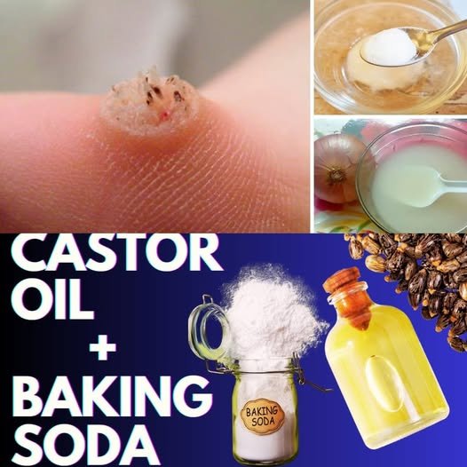 Banish Warts Naturally with Castor Oil & Baking Soda