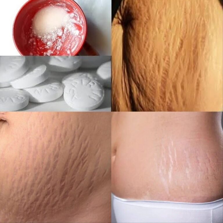 Can Aspirin Remove Stretch Marks in Just 7 Days? The Truth About This Viral Skin Trick